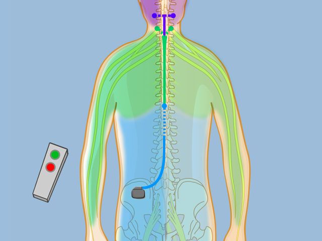 spinal cord stimulation