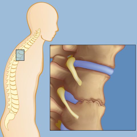 Ankylosing Spondylitis