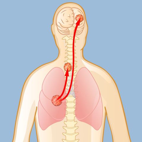 Metastatic Brain and Spine Tumors