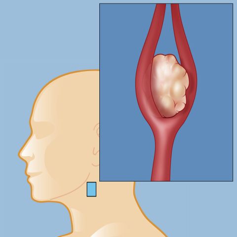 Carotid body tumor
