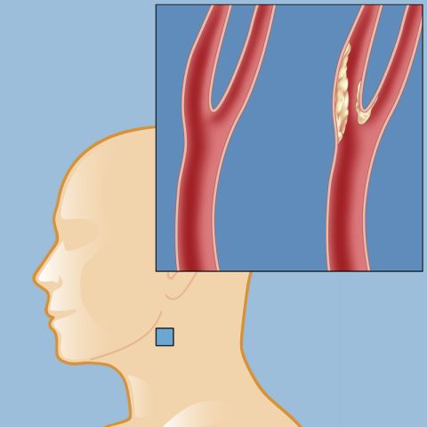 Carotid Occlusion