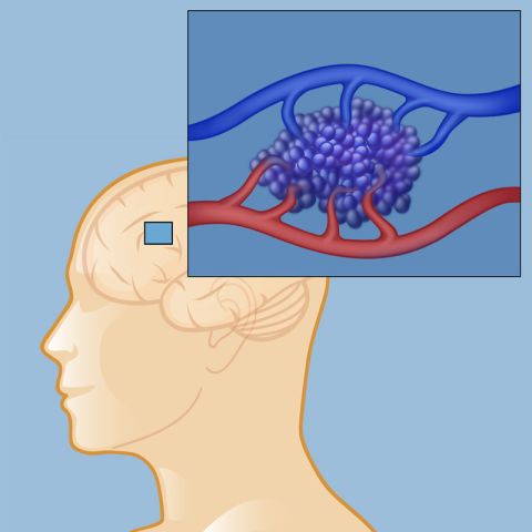 Cavernous malformation