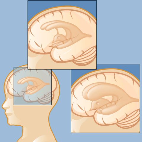 Hydrocephalus Hydrocephalus