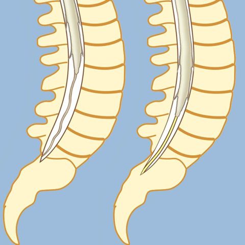Tethered spinal cord