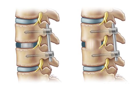 TLIF spinal fusion
