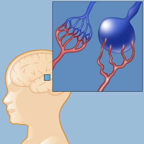 Vein of Galen Malformation