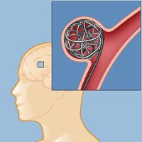 Coiling Platinum coils are placed inside the aneurysm from the artery.