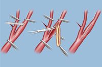 Carotid Endarterectomy carotid endarterectomy diagram