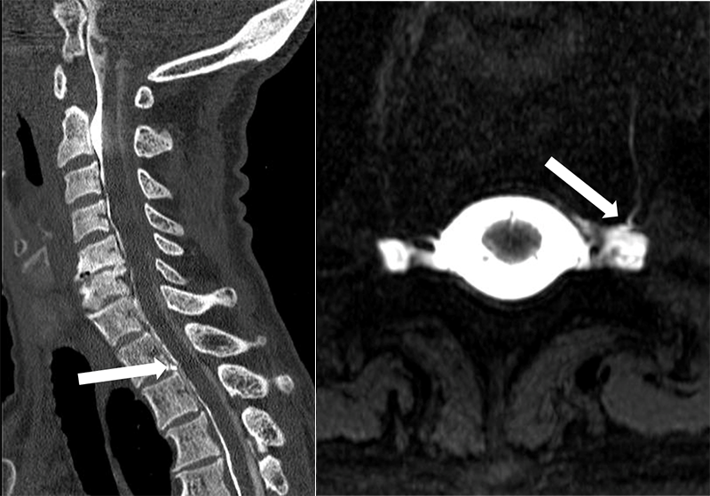 Cerebrospinal Fluid Leak