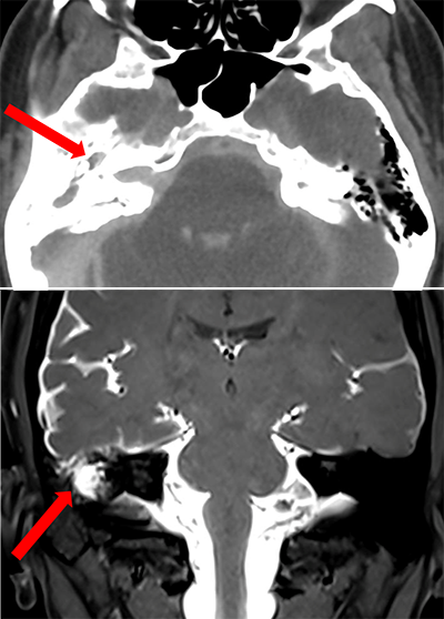 Cranial CSF leak