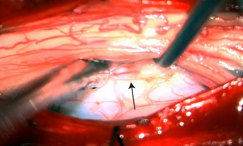 Photo from a surgery repairing a spinal dural tear (arrow) caused by a bone spur.