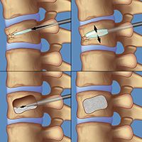 Kyphoplasty steps of a kyphoplasty