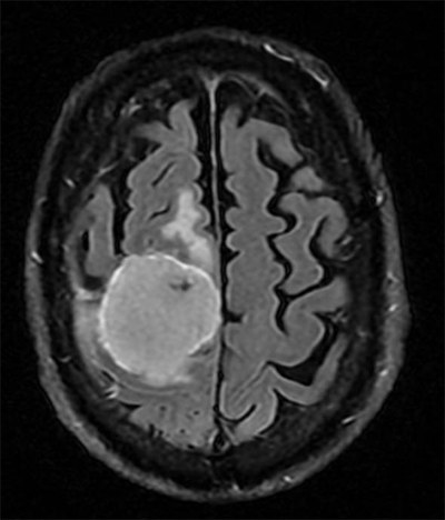 Smoky Wurtzel's meningioma had grown considerably in the 28 years since it was first identified