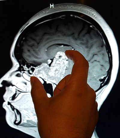 Eneida Ramos's tumor Eneida Ramos's tumor