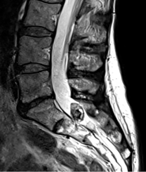 A pre-operative MRI scan revealed that Orna had a tumor on her spine, but it could not provide more precise information about it. A pre-operative MRI scan revealed that Orna had a tumor on her spine, but it could not provide more precise information about it.