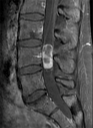 Jamie's tumor on pre-operative scan