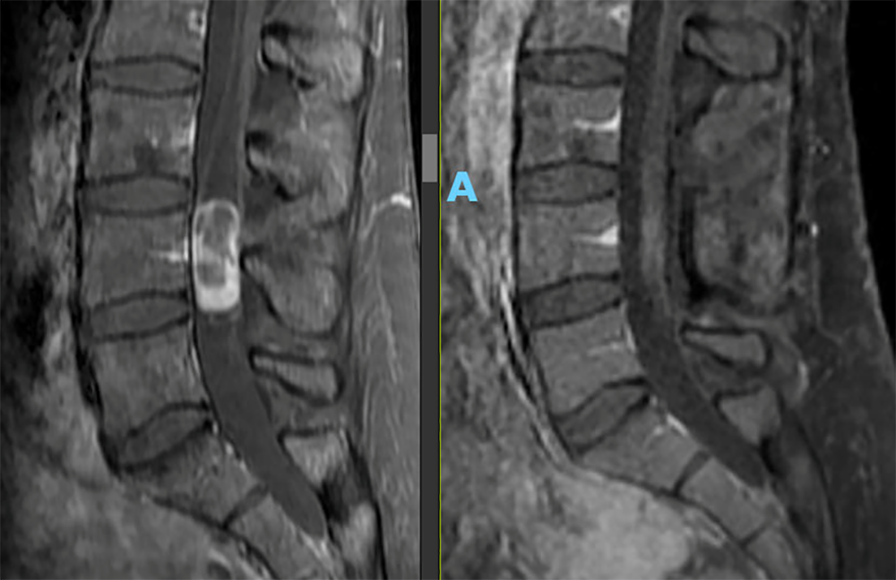 Jamie's pre- and post-operative scans show a complete resection of the tumor Jamie's pre- and post-operative scans show a complete resection of the tumor