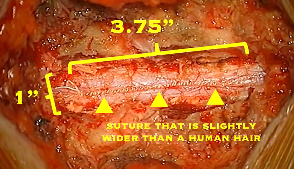 After the tumor is removed, the dura must be carefully closed