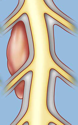 Laura's tumor was extradural, meaning it was outside of the dura. These are the most common type of spinal tumors, forming outside the spinal cord and the dura in the bones and cartilage of the vertebrae. Laura's tumor was extradural, meaning it was outside of the dura. These are the most common type of spinal tumors, forming outside the spinal cord and the dura in the bones and cartilage of the vertebrae.