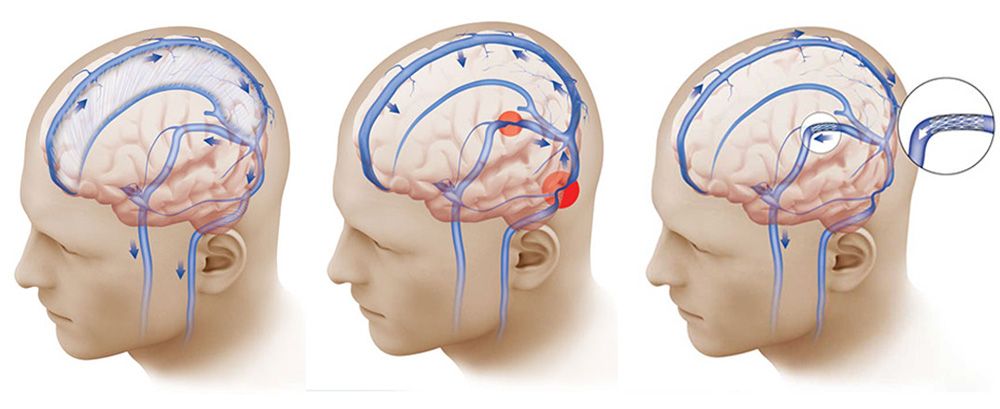 Normal pressure in the brain is maintained by a system that drains cerebrospinal fluid (left). In some people, a narrowing in those draining veins (red circles, center) interfere with that balance. A stent in those veins (right) can relieve the pressure Venous Sinus Stenting for pulsatile tinnitus and IIH