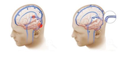 Before and After A stent is placed to restore blood flow through narrowed vein.