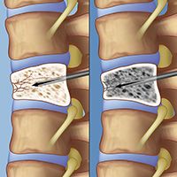 Vertebroplasty steps of a vertebroplasty