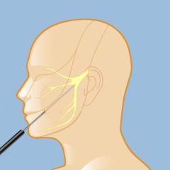 RFL for trigeminal neuralgia RFL for trigeminal neuralgia
