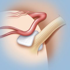 Microvascular decompression surgery for trigeminal neuralgia Microvascular decompression surgery for trigeminal neuralgia