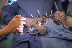Neurological surgery - clinical trial at Weill Cornell Brain and Spine Center