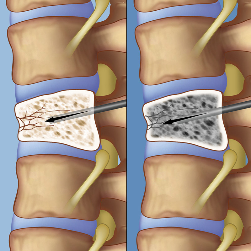 In a vertebroplasty, a surgeon injects bone cement into the fractured vertebra, where it quickly hardens to provide stability to the bone and relief of pain.
