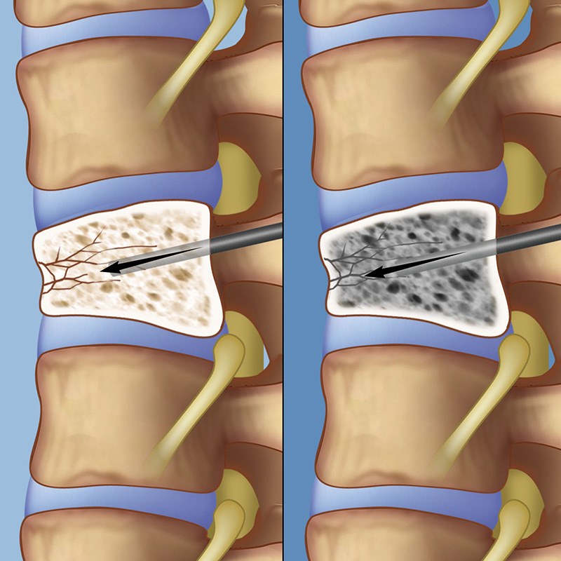 Surgery For Spinal Compression Fractures Weill Cornell Brain And Spine Center 