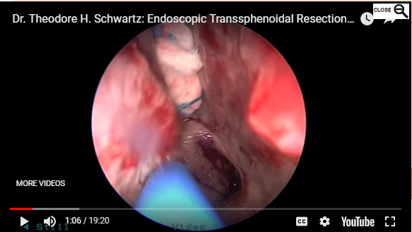 Endoscopic Transsphenoidal Resection of Pituitary Macroadenoma